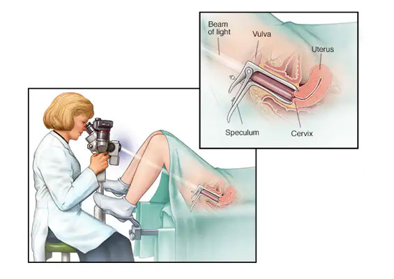 Colposcopy