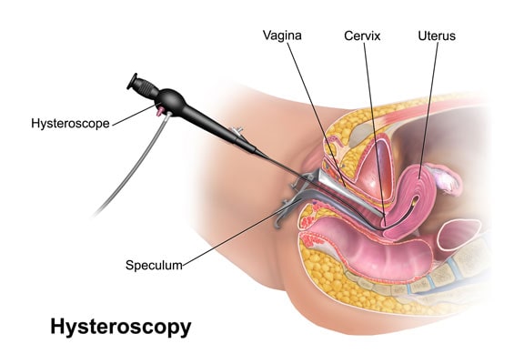 Hysteroscopy
