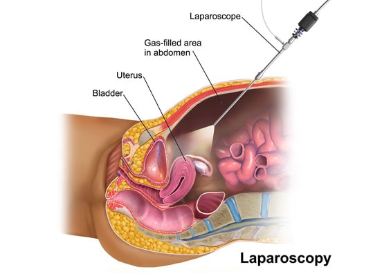 Laparoscopy