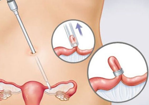 Family Planning Surgery